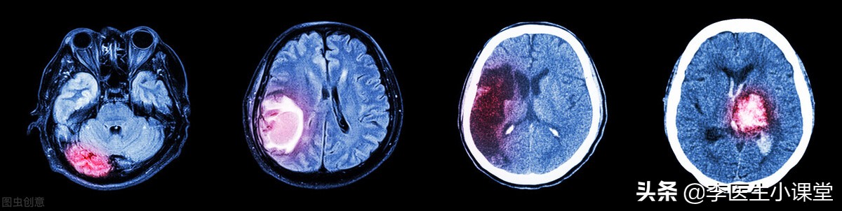 家人突发脑出血咋办？医生教你几个家庭急救办法，关键时候能救命