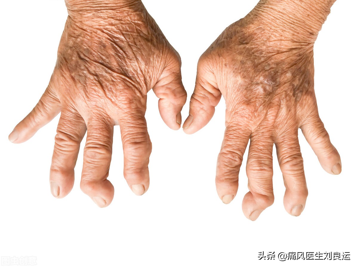 痛风发作大脚趾不能活动,痛风发作时只痛不肿不热为什么