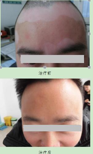 不能忽视的白癜风疾病危害,白癜风被误诊的危害