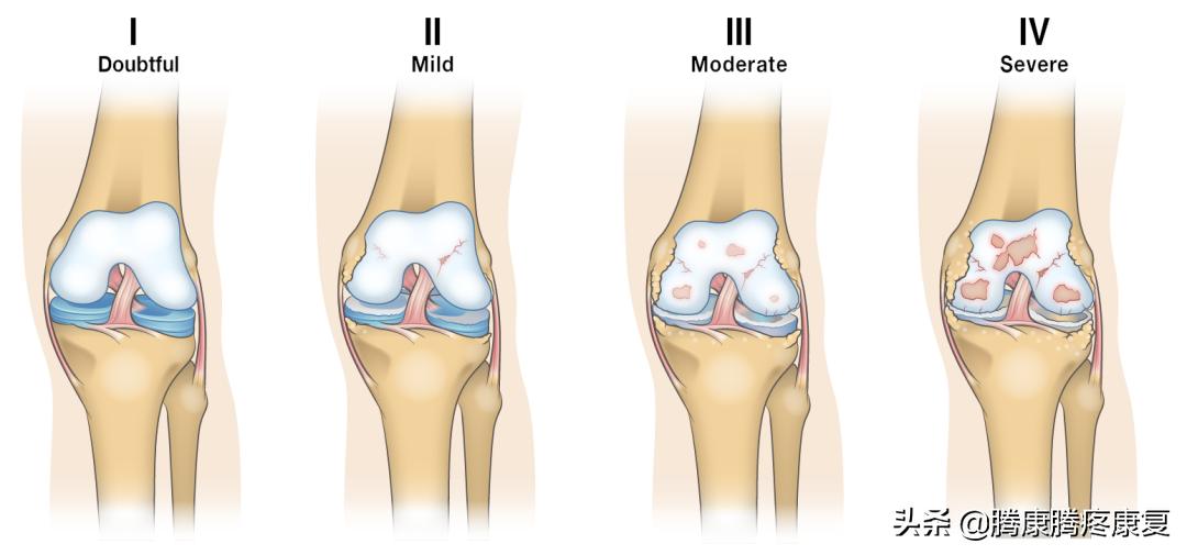 类风湿关节炎病因与发病机制,类风湿关节炎的病因与发病机制
