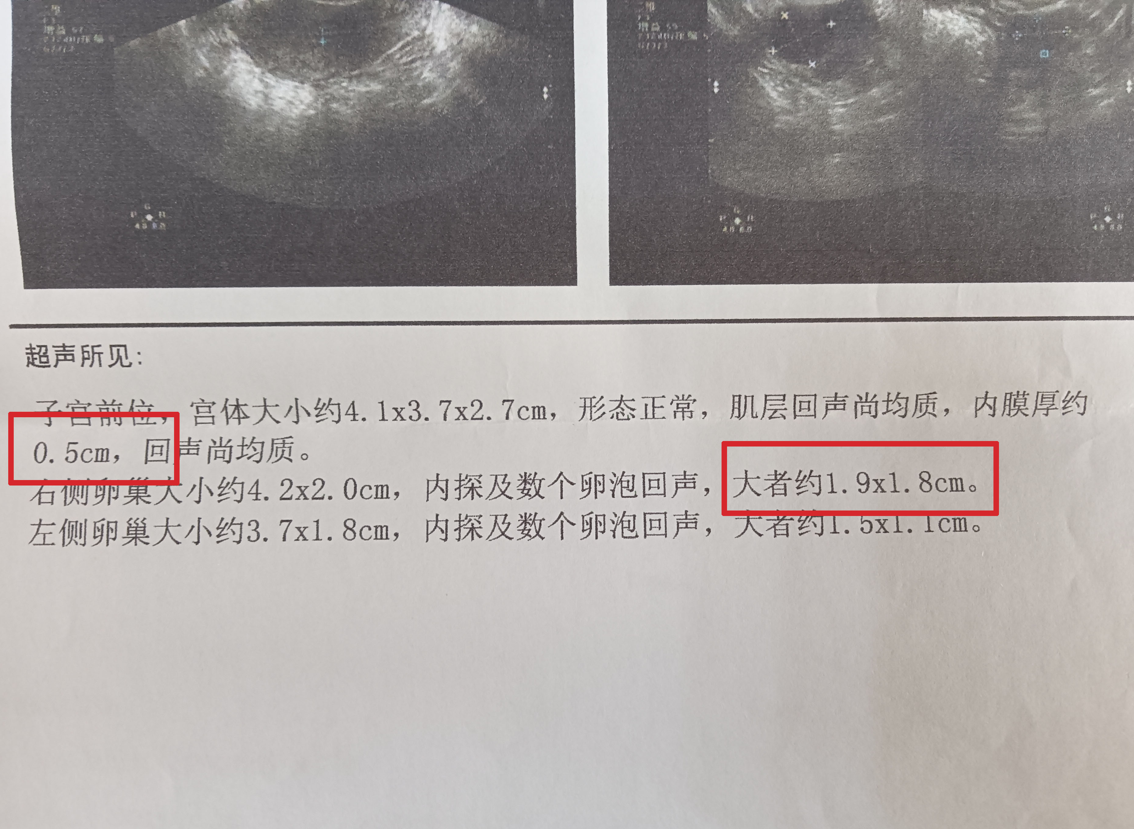 子宫内膜薄产后会内膜厚吗,人流后多年发现子宫内膜厚薄不均