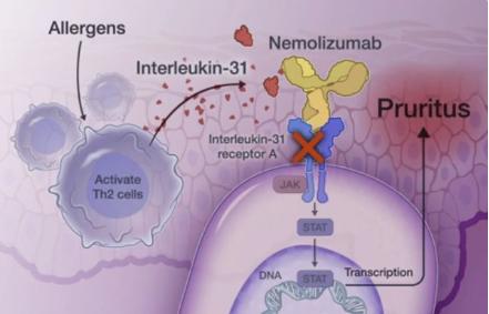 皮炎湿疹抗真菌药膏,皮炎湿疹抗过敏的药