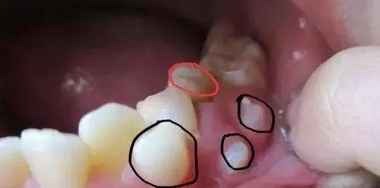 换牙后新牙锯齿状怎么回事,小孩换牙后长出来的牙是锯齿状的