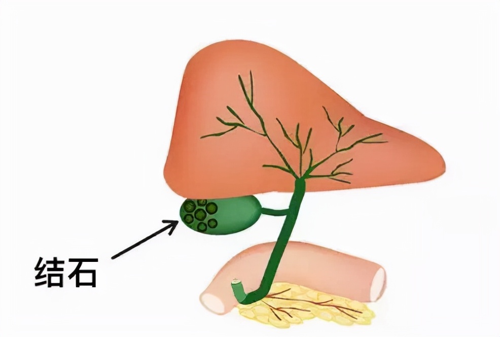 老生常谈和人尽皆知区别,胆结石跟胃病有关系吗