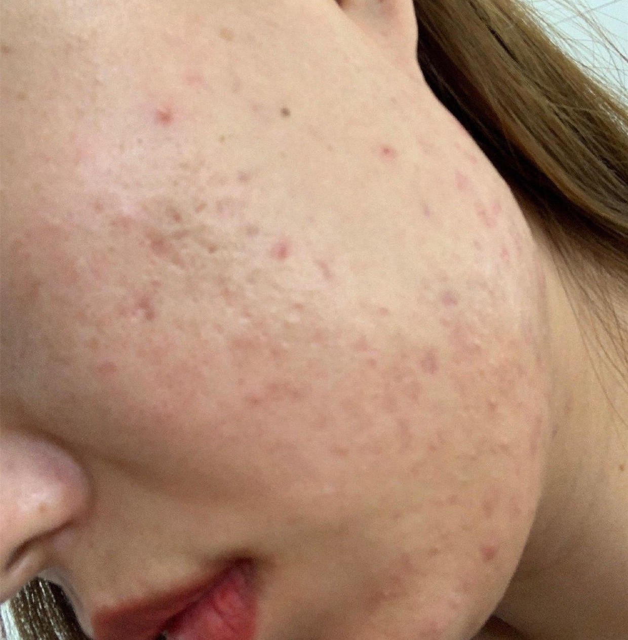 为啥要去脸部角质,为什么要去皮肤上的角质