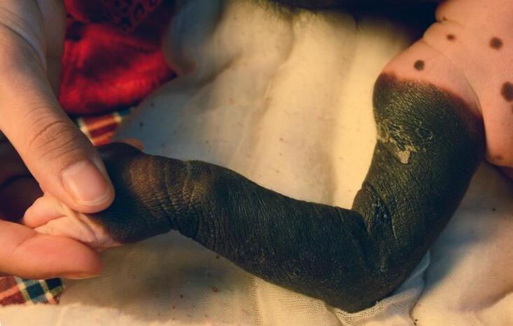 面积大的黑毛痣最好的治疗办法,宝宝黑毛痣上哪个医院治疗