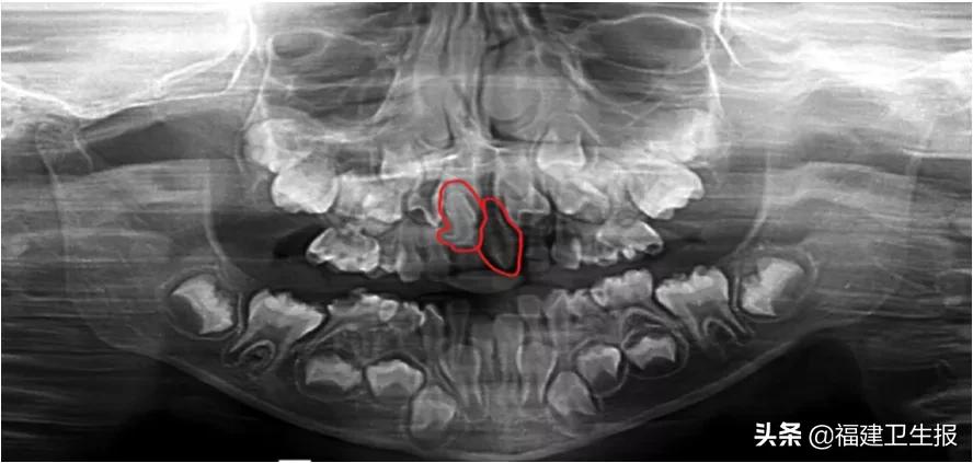 宁德7岁女孩嘴里长了两颗奇怪的新牙，医生：幸好来得及时