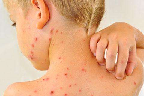 麻疹注意事项有哪些,麻疹最应警惕的并发症