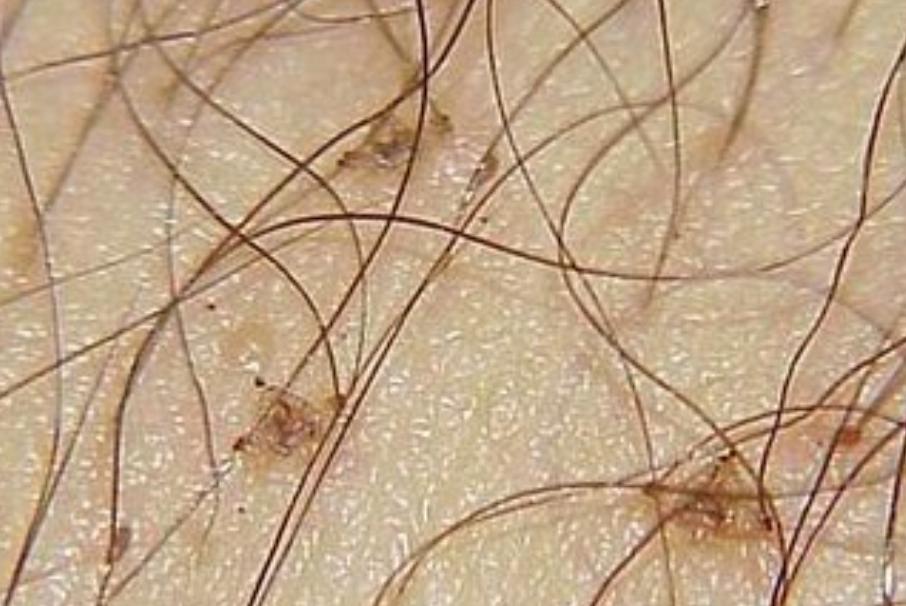 阴虱病如何传播,阴虱病是怎么传播来的