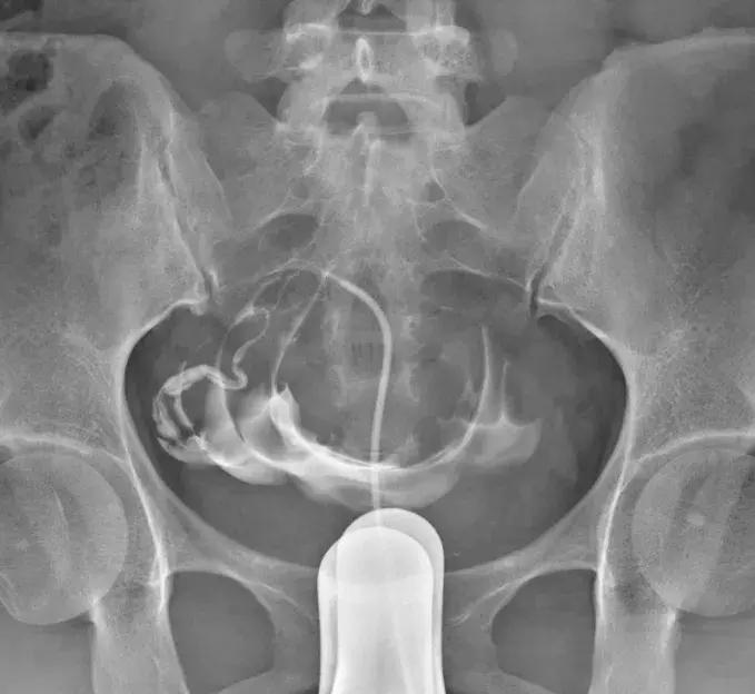 输卵管性不孕的最佳治疗方法,输卵管性不孕的中医治疗要点