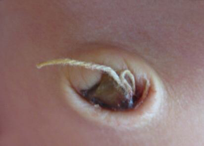 新生儿特殊生理现象照片,新生儿的正常生理现象