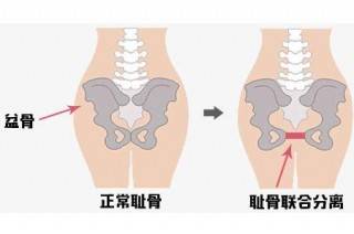 耻骨痛和宫缩痛有啥区别,宫缩疼得厉害却不开指