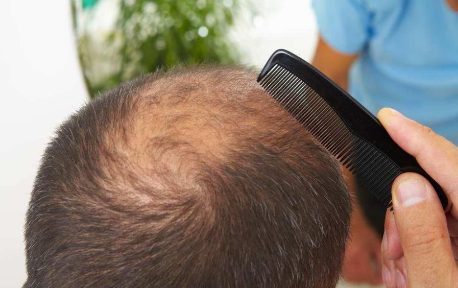 健康之路拯救脱发危机,人到中年脱发怎么自救