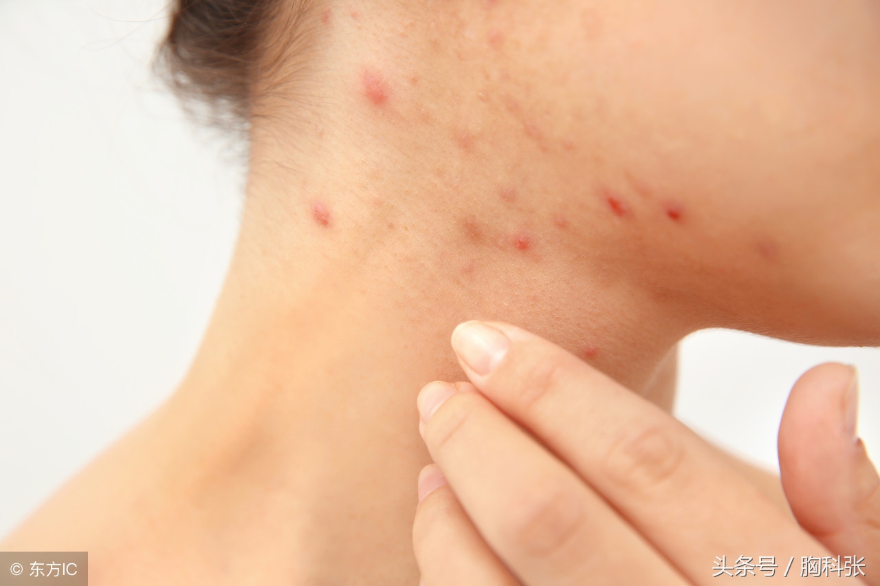 医生胸科张告诉你:遇到药物过敏,我们该怎么办?