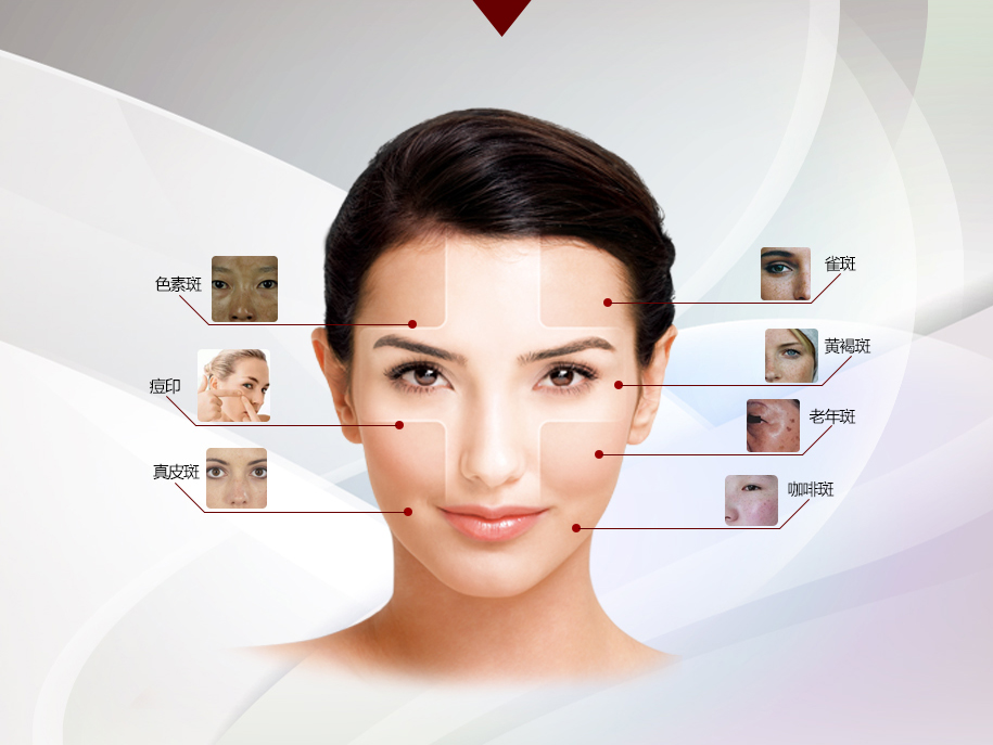 激光祛斑的十大忠告,激光祛斑面面观
