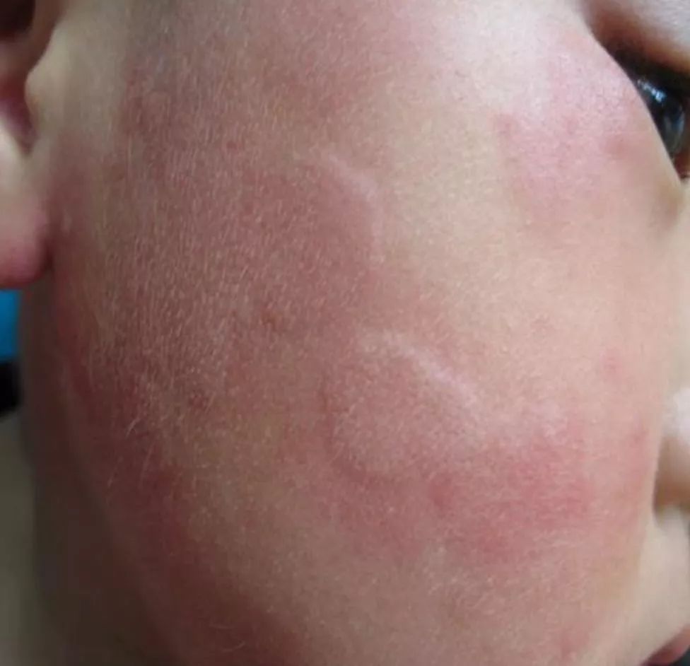 小孩突然全身发痒啥原因,孩子突然全身发痒怎么治病