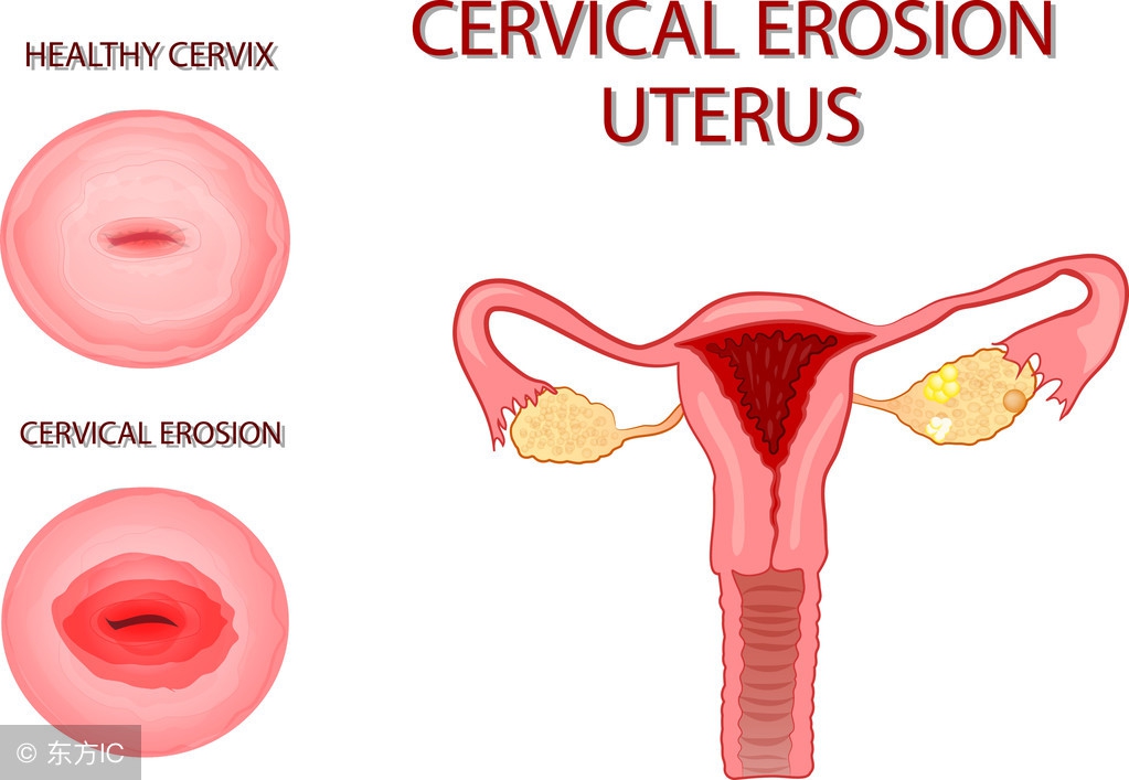 没结婚的女性会有宫颈糜烂吗,女生没结婚会得阴道炎吗