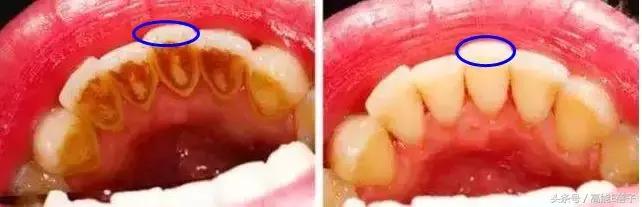 高圆圆牙齿美白,高圆圆40岁美白秘诀