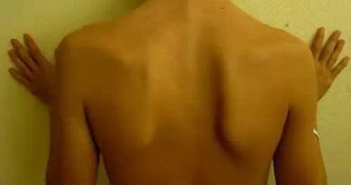 肩关节软组织损伤康复的最佳方法,打篮球肩峰撞击症最佳锻炼方法