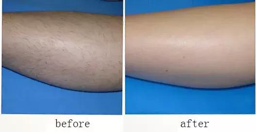 一秒脱毛,如何在一分钟内脱毛