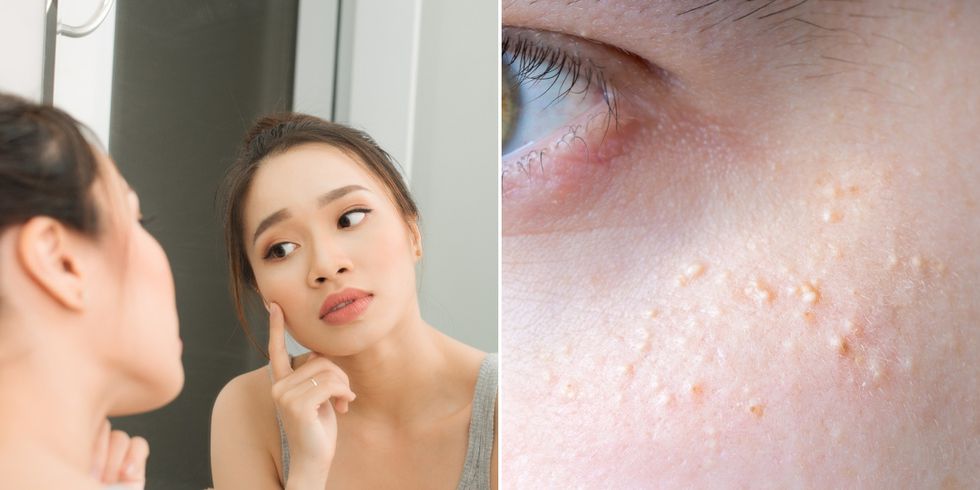 脸上莫名的小颗粒到底是什么？皮肤专家教你护肤