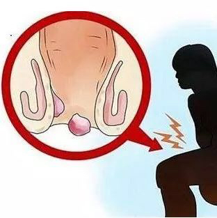 痔疮怎么不治而愈,痔疮有什么方法不让它发作