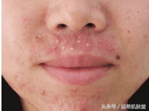 35岁女性脸上反复长痘痘怎么调理,下巴长满痘痘是什么原因怎么调理