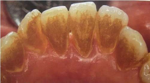 牙周炎牙龈出血怎么治疗,中医治疗牙龈出血的方法