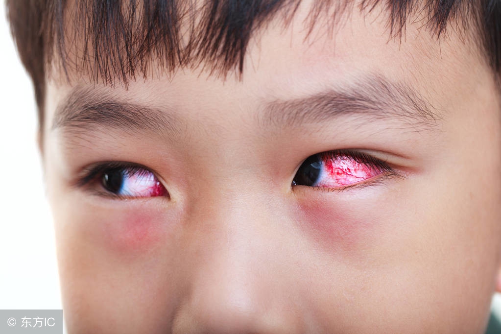 眼结膜炎是不是红眼病,结膜炎与红眼病的区别是什么