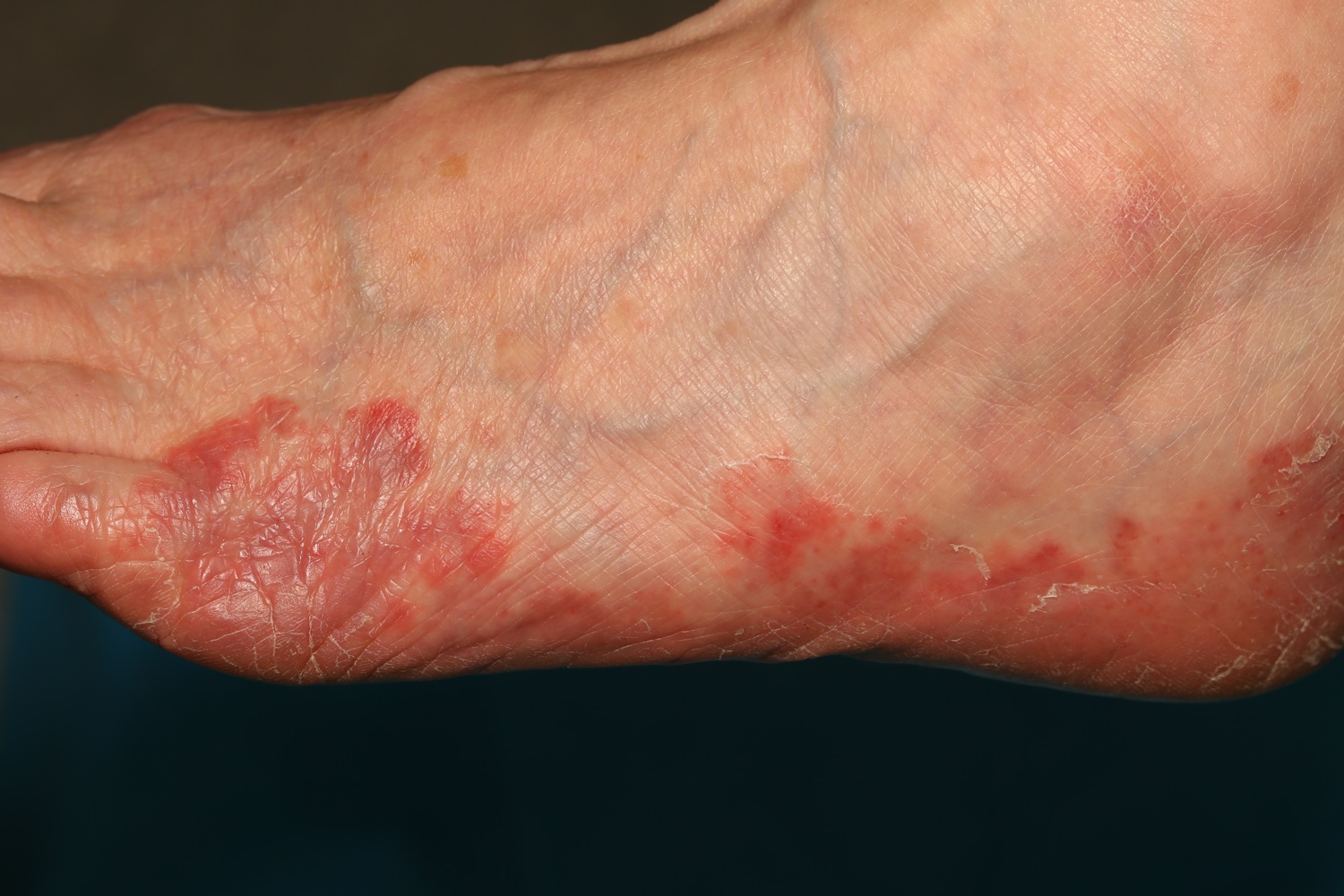 脚痒肿大真菌感染怎么办,脚真菌感染很痒用什么药