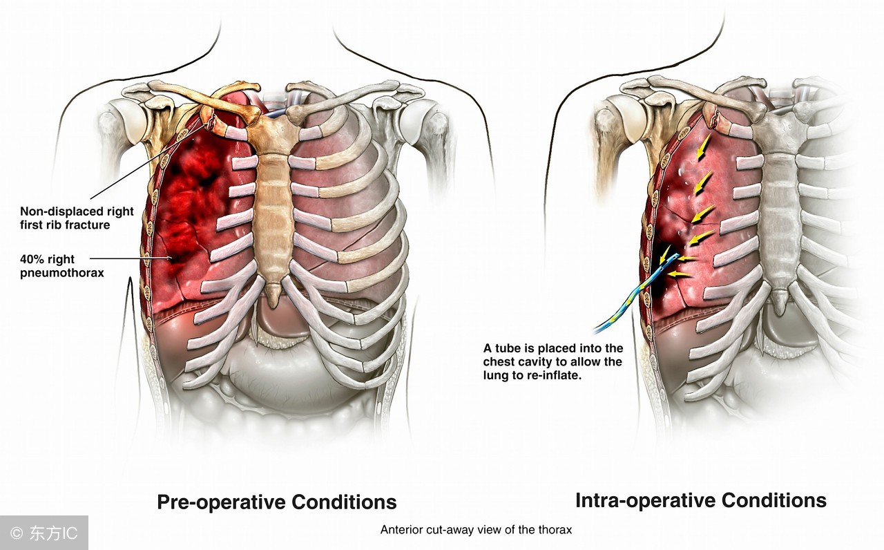 肋骨骨折引起肺栓塞几率大吗,肋骨骨折胸腔积液肺栓塞