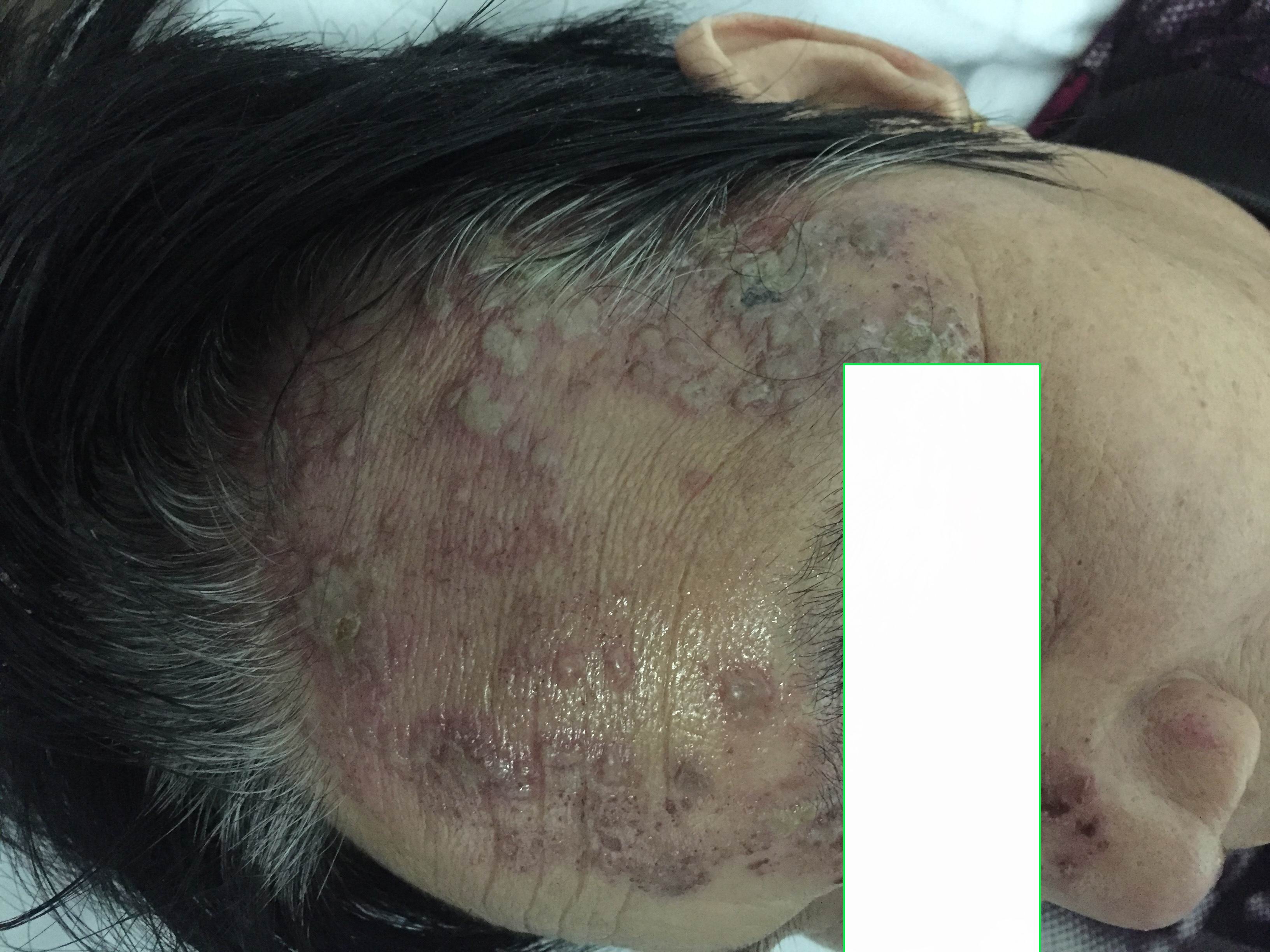 带状疱疹眼睛疼多久能好,眼带状疱疹对眼睛的影响