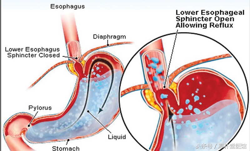 反流性食管炎会不会导致ca724升高,反流性食管炎如何迅速缓解