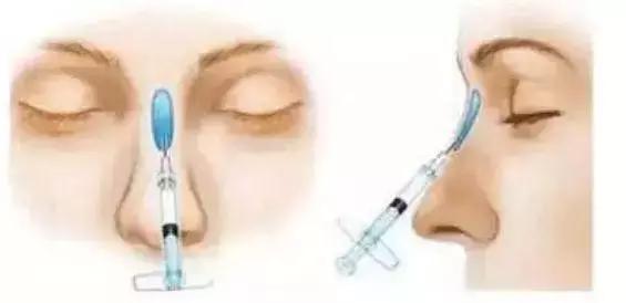 整形“神器”大测评：传说中的隆鼻夹真的靠谱吗？