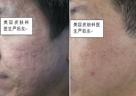 皮肤科修复痘坑大全,痘印痘坑修复皮肤科医生