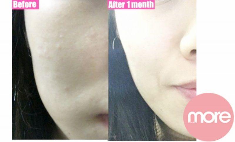 娥罗纳英软膏可以去黑头吗,娥罗纳英软膏祛闭口粉刺可以吗