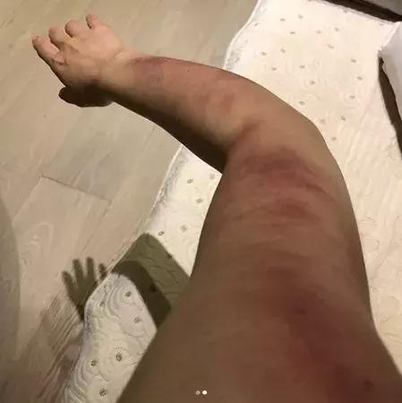 触目惊心！杨丞琳阿娇等人把刮痧过度神话，专家打脸：根本没效果