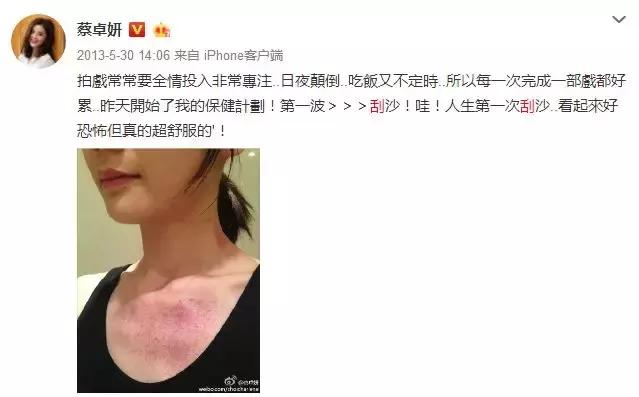 触目惊心！杨丞琳阿娇等人把刮痧过度神话，专家打脸：根本没效果
