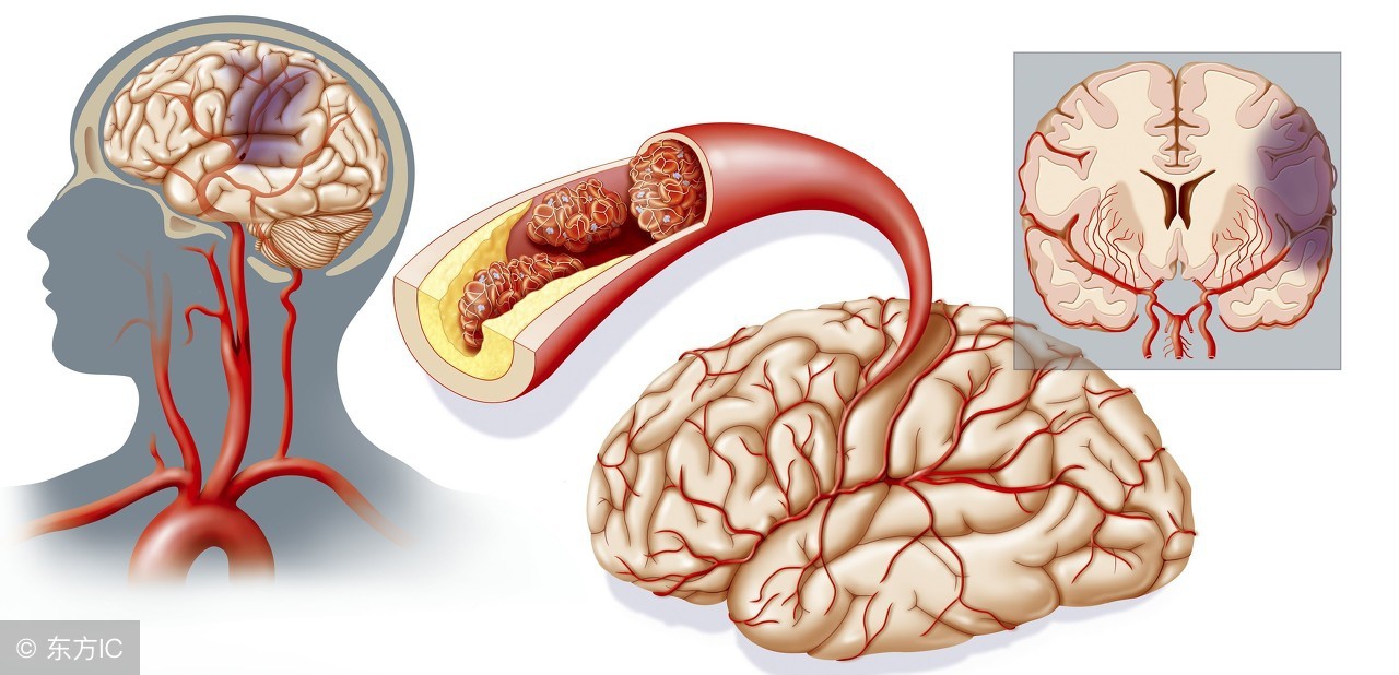 右侧基底节区腔隙性脑梗塞的症状,腔隙性脑梗塞脑软化灶是什么症状