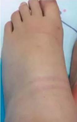 女子发照片晒自己丑丑的大象脚却感动了朋友圈