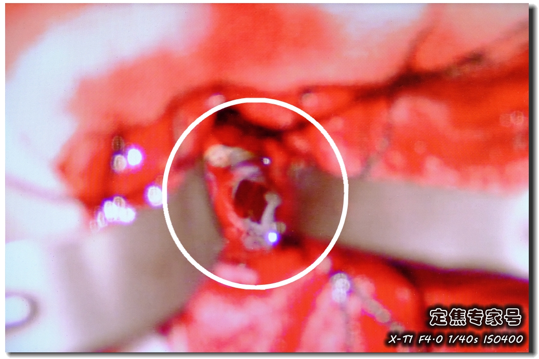 它伪装成发烧感冒侵入女童颅脑，最终却让妈妈连夜千里奔袭