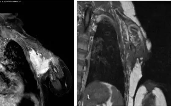 膀胱肿瘤的新疗法,最新治疗肿瘤的特效药