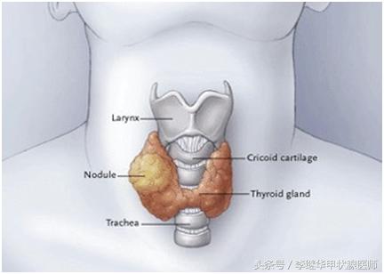 甲状腺疾病教学,不同类型甲状腺结节饮食注意事项