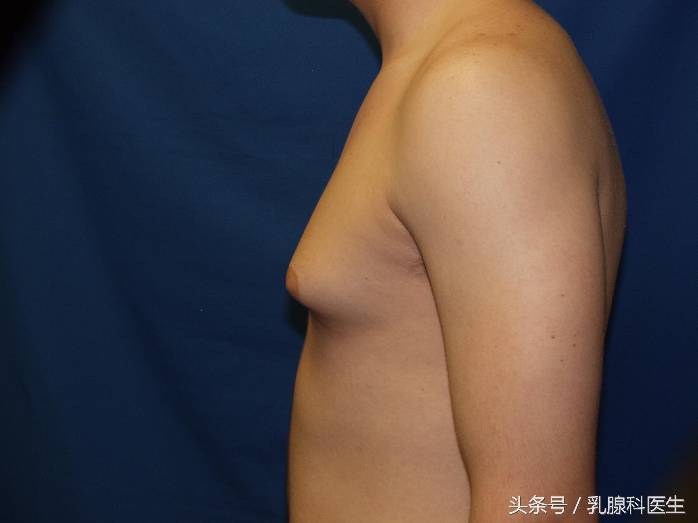 乳腺增生、乳腺炎、乳腺癌会发生在男人身上吗？