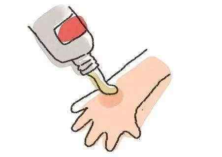 烧水烫伤紧急处理,烫伤烧伤的紧急处理ppt