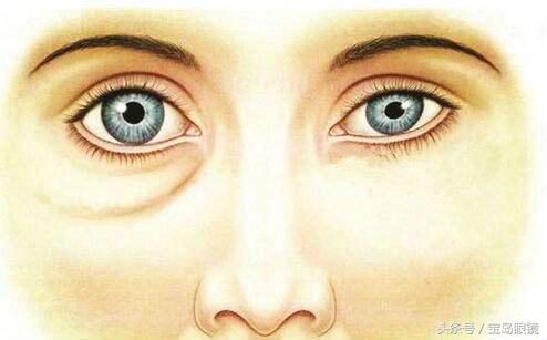 近视眼会导致眼袋大吗,近视眼不戴眼镜会眼窝凹陷