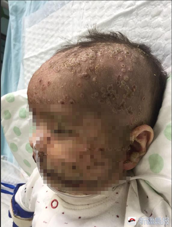 宝宝长水痘什么情况下住院治疗,40天的宝宝刚得水痘吃药控制住吗