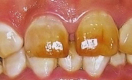 虫牙的形成和治疗,虫牙的由来是什么