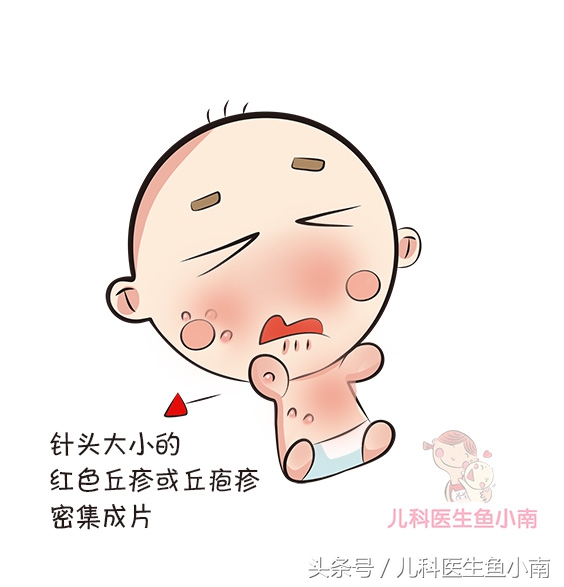 宝宝湿疹和热疹的正确护理方法,宝宝湿疹不同问题不同治疗方法