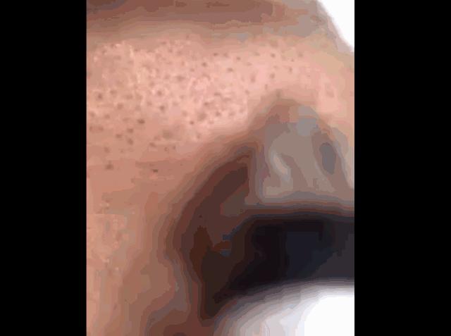 别傻了！蔡徐坤、Angelababy都根治不掉的黑头，微商神器能去除？